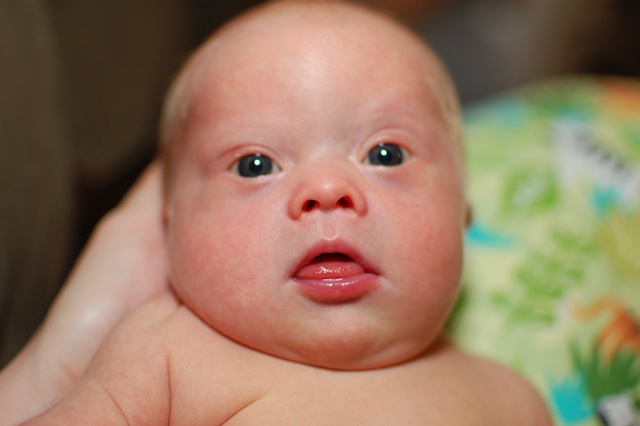 almond shaped eyes down syndrome