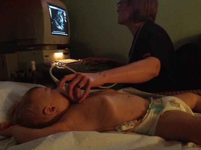 echocardiogram baby test down syndrome baby