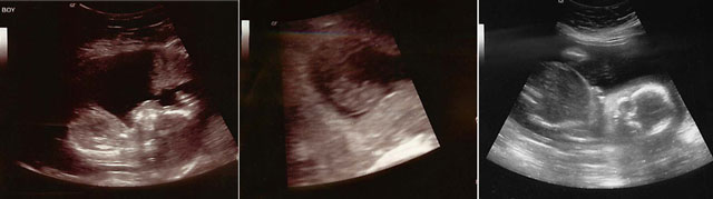 our little boy with down syndrome in the womb