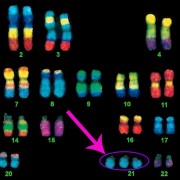 down syndrome chromosome chart