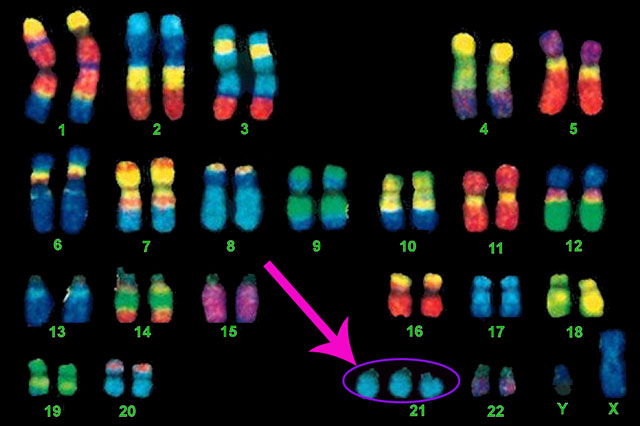 down syndrome chromosome chart