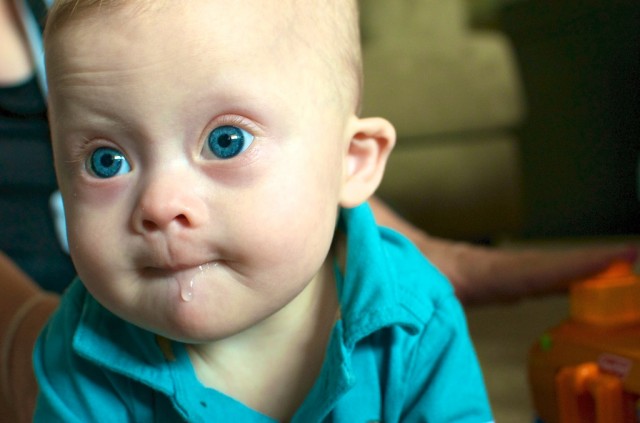 baby boy with downs down syndrome with big blue eyes