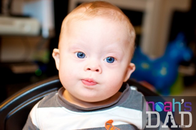 cute down syndrome boy blue eyes