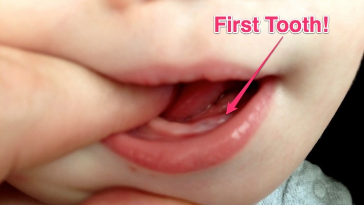 babys first tooth teeth 10 months old down syndrome