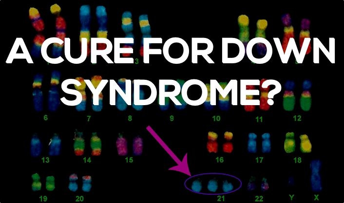 down-syndrome-cure