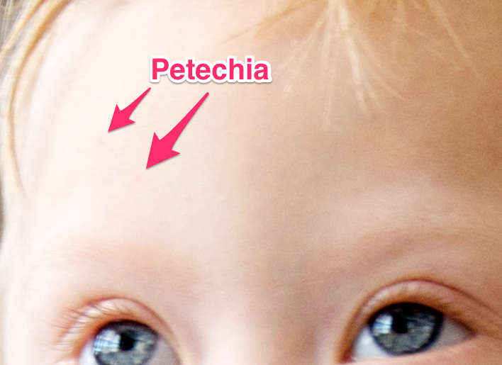 close up of petechia special needs baby toddler head forehead