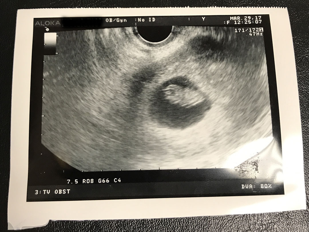 9 week old baby sonogram picture